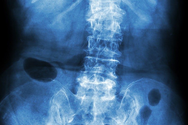 Film x-ray lumbar - sacrum spine show crooked spine caused by Spondylosis and Scoliosis