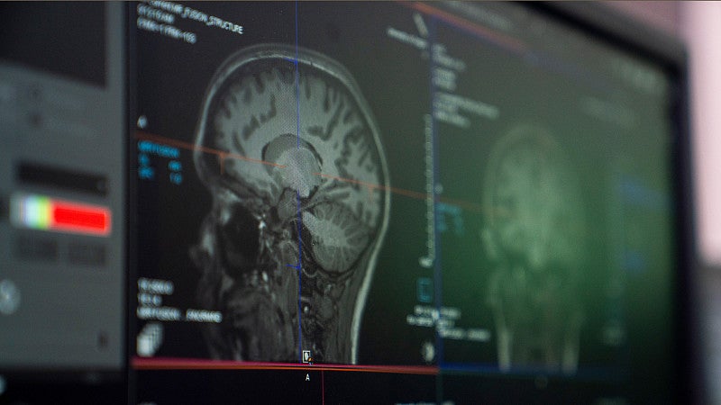 A brain scan on a computer screen