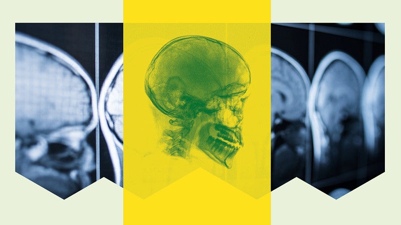 A graphic of a human skull in an x-ray