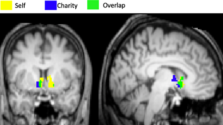 Brain MRI