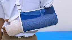 Man with a broken arm in a cast