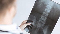 Doctor looking at spinal x-ray