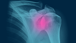 Shoulder X-ray